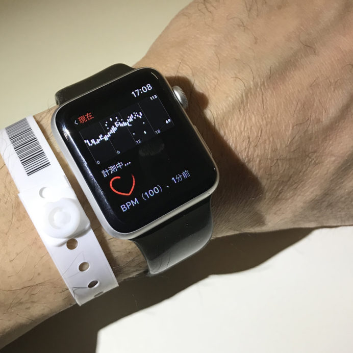 Apple Watchがどうやって私の心房細動を発見したか 自炊自賛